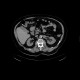 Kidney tumour, RFA: CT - Computed tomography
